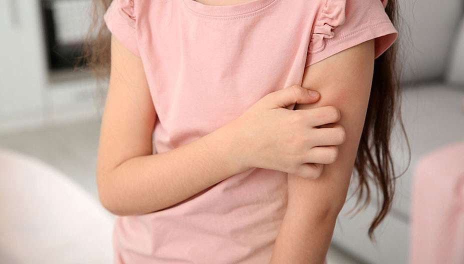 אטופיק דרמטיטיס