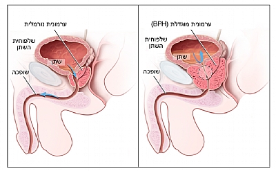 ערמונית מוגדלת